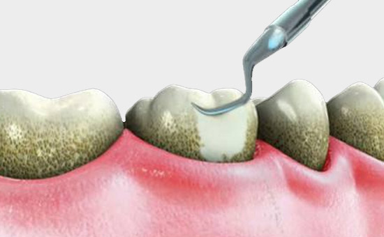 牙周治疗